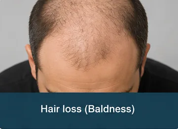 Man examining hair loss and thinning crown before baldness treatment