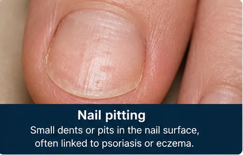 Nail pitting with small dents in the nail surface, often linked to psoriasis