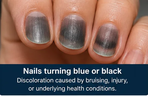 Nails turning blue or black due to discoloration or an underlying health condition