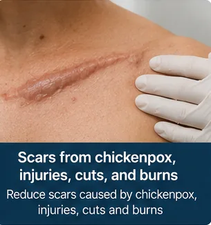 Large scar from chickenpox or injury before scar-reduction treatment