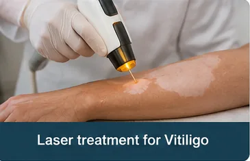 Dermatologist performing laser treatment for vitiligo on a patient's arm
