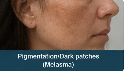Facial pigmentation and dark patches (melasma) before dermatology treatment