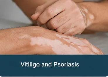 Vitiligo and psoriasis patches on the hand before dermatology treatment